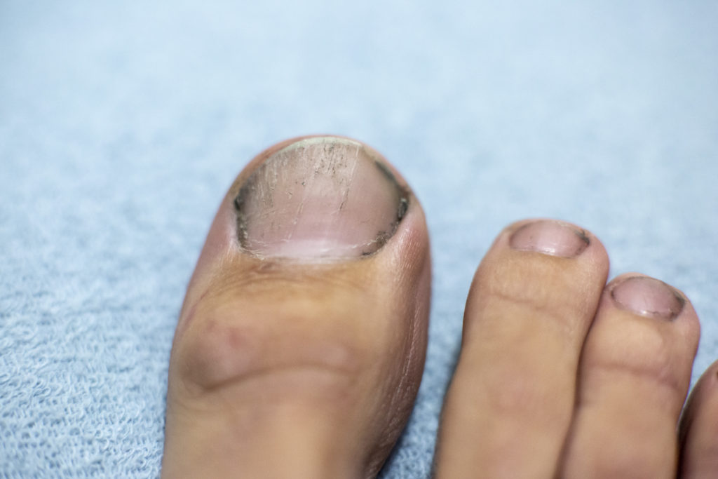 dirty toe